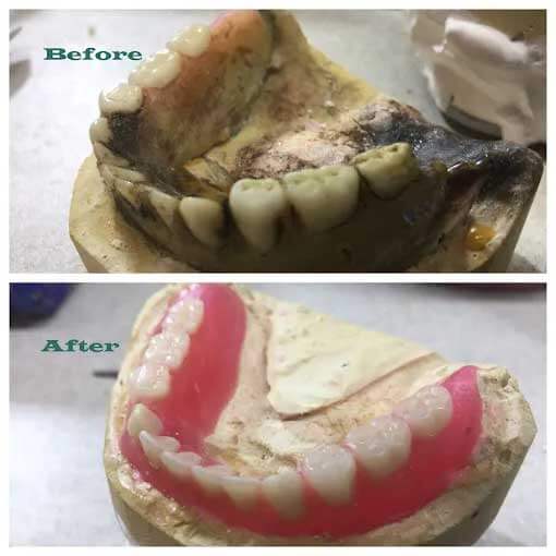 Before and After of Denture Repair