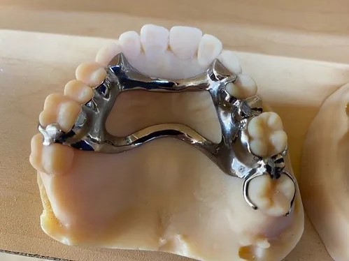 Titanium Partial Dentures